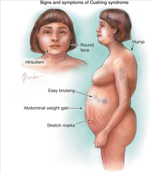 Gejala-gejala Cushing Syndrom akibat akumulasi steroid dalam tubuh